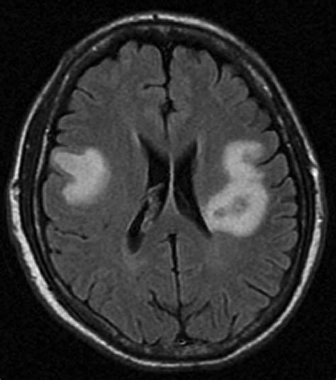 Brain abscess causes, signs, symptoms, diagnosis, treatment & complications