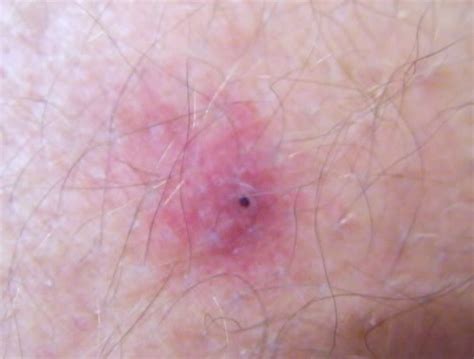 Tick Bites – Pictures, Symptoms, Causes, Treatment : Medical Treasure