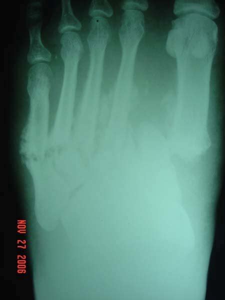 Dorsoplantar view reveals complete dislocation of the first metatarsal ...