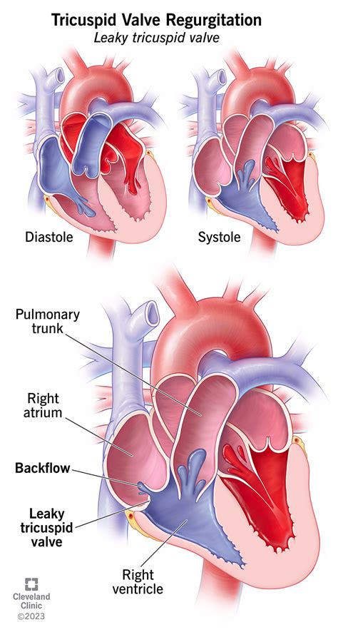 Tricuspid Valve