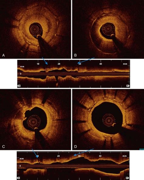 Treatment of In-Stent Restenosis | Thoracic Key