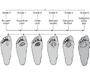 Wagner Ulcer Grade Classification Scale flashcards | Quizlet