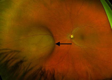 Choroidal Melanoma