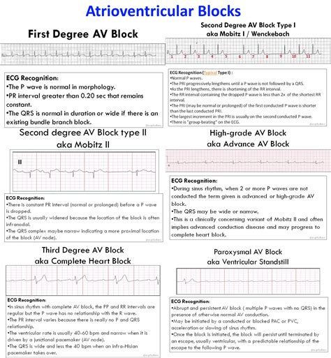 Ecg Blocks