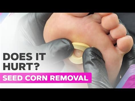 How To Remove Corn After Using Corn Cap: A Simple Guide