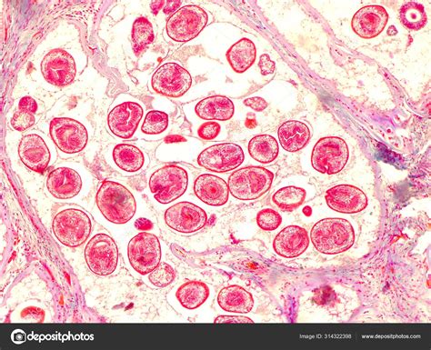 Echinococcal cyst under the microscope (400x). Echinococcus granulosus ...