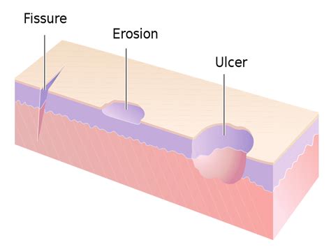 Types Of Wound Ulcers