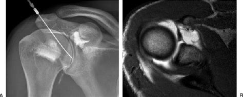 Anterior approach to shoulder arthrogram performed with the patient in ...