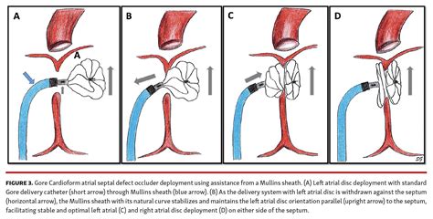 Mullins-Sheath Facilitated Delivery of Gore Cardioform ASD Occluder ...