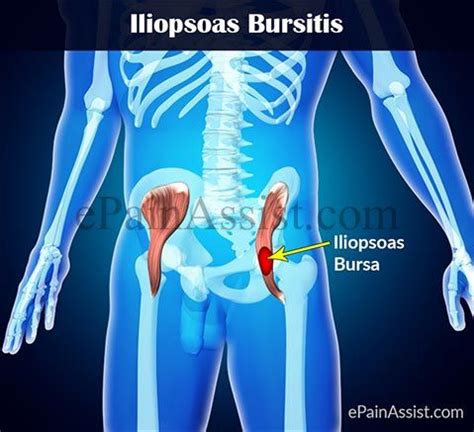 Pin by Kelly c on psoas/fitness/stretches | Iliopsoas bursitis ...