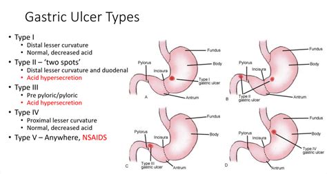 Modified Johnson Classification for Gastric Ulcers