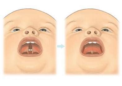 Cleft Palate Repair Surgery - Oral Health