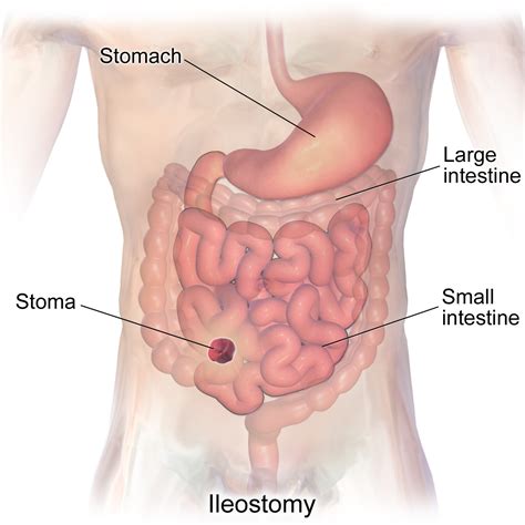 What Is an Ileostomy? - StoryMD