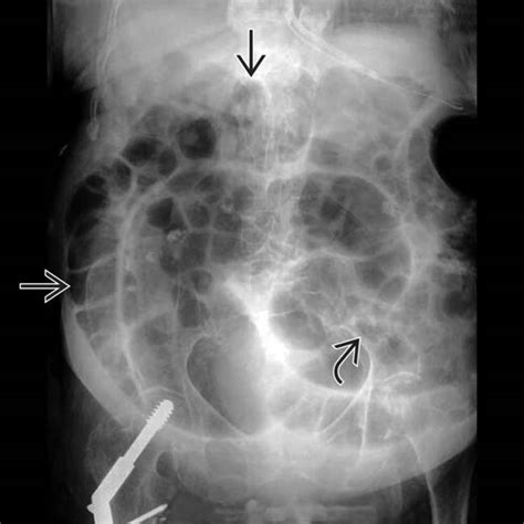 Ileus | Clinical Gate