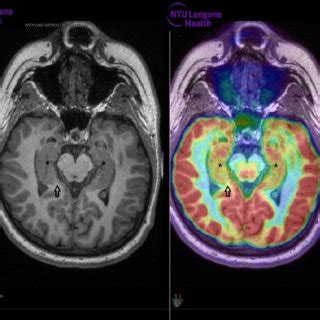 (PDF) Hashimoto Encephalopathy: Impact of Concussion