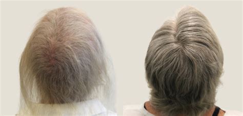 Chemotherapy Hair Loss Timeline