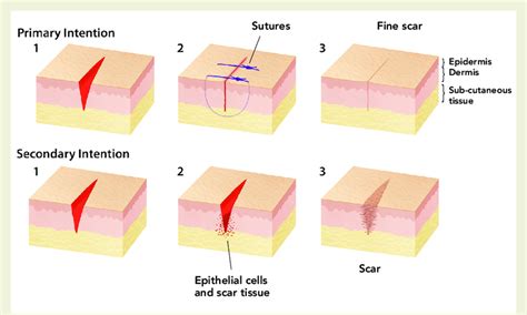 Difference in wound healing between primary and secondary intention ...