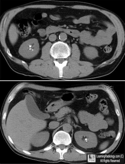 LearningRadiology - medullary, sponge, kidney