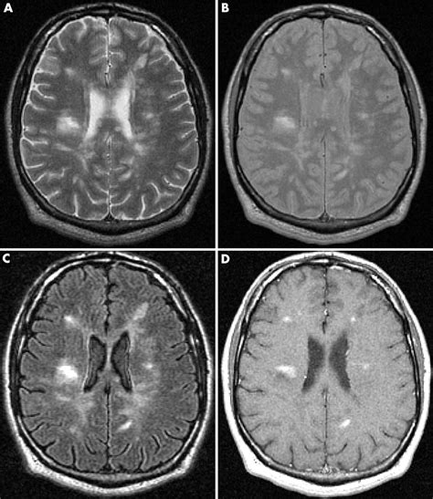 [신경과학] 다발성 경화증과 탈수초 질환 MRI : 네이버 블로그