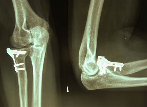 Radial head fracture - ElbowDoc