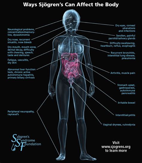 Sjögren's Syndrome & Long Term Disability - Mcdonald and Mcdonald