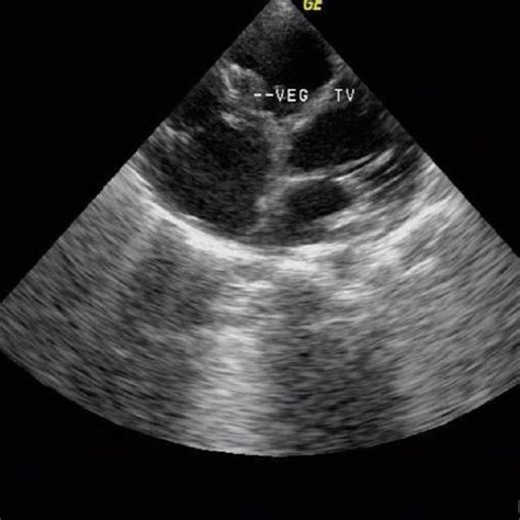 Transthoracic echocardiogram shows tricuspid valve vegetations on ...