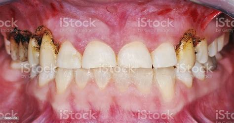 Gingivoplasty Procedure Stock Photo - Download Image Now - Blood ...