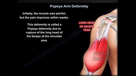 Proximal Biceps Tendon Rupture / Popeye Deformity - - YouTube