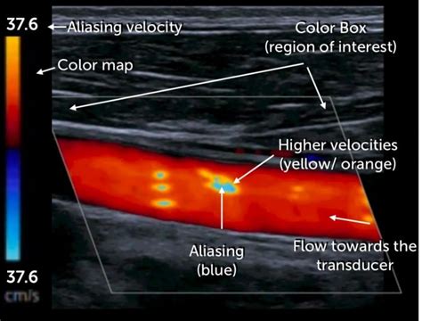 3. Instrumentation and physical principles of carotid (Duplex ...