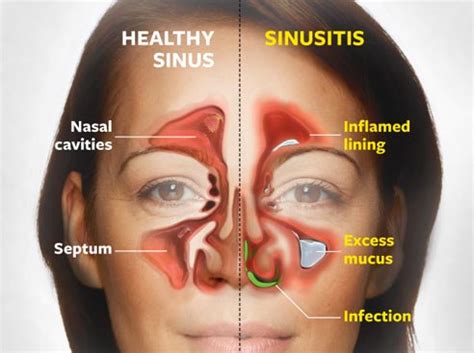 How To Prevent Constant Sinus Infections - Pacific Eye & Ear Specialists