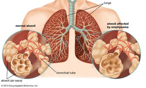 Emphysema | Causes, Symptoms & Treatment | Britannica