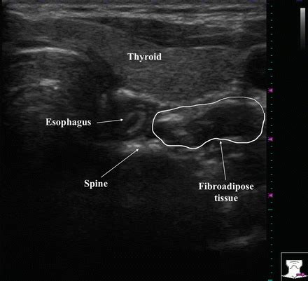 Normal Thyroid Appearance and Anatomic Landmarks in Neck Ultrasound ...