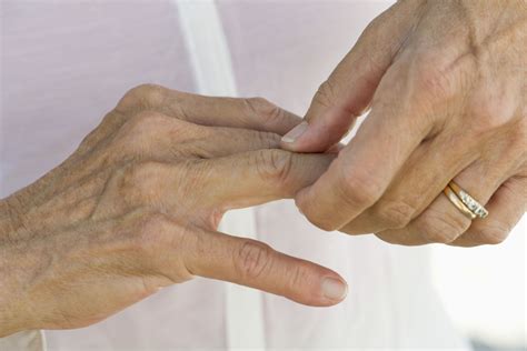 How to Get Rid of Arthritis in the Fingers