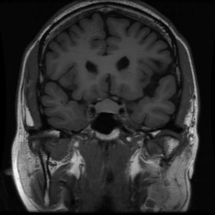 Pituitary hyperplasia | Radiology Reference Article | Radiopaedia.org