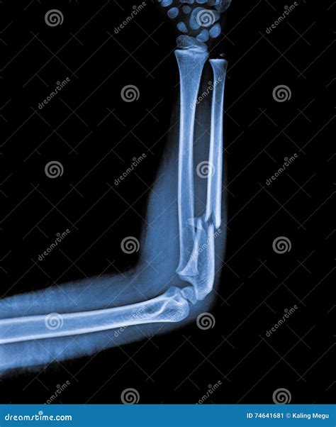 X Ray Of Hand With Fracture Stock Image | CartoonDealer.com #74641681