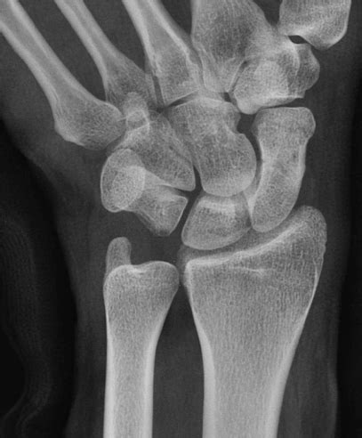 EMRad: Radiologic Approach to the Traumatic Wrist