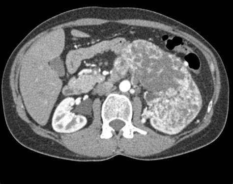 Renal Cell Carcinoma - Kidney Case Studies - CTisus CT Scanning