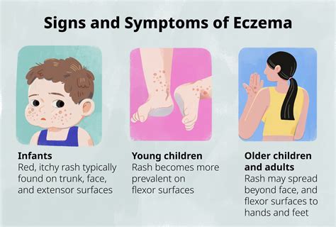 How to Identify Eczema in Children