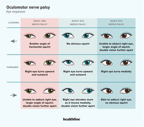 Your Guide To Oculomotor Nerve Palsy And Its Treatment, 52% OFF