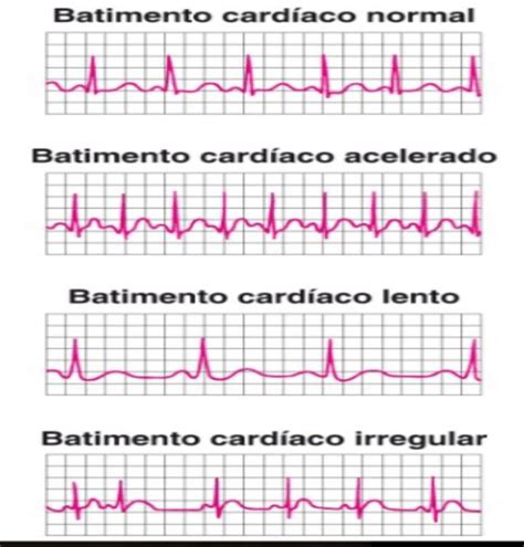 Arritmia Cardiaca Electrocardiograma Ventricular Arrhythmias | The Best ...