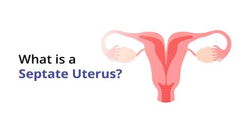 Understanding Septate Uterus: Causes, Symptoms, and Treatment | Birla ...