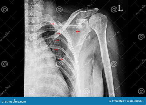 Chest X-ray Fracture Right Clavicle Royalty-Free Stock Image ...