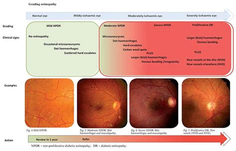 Severe, Eyes, Hemorrhage