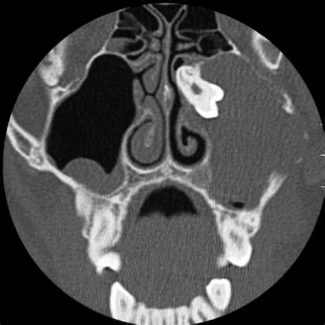 -Dentigerous cyst. A, A panoramic radiograph shows a large ...