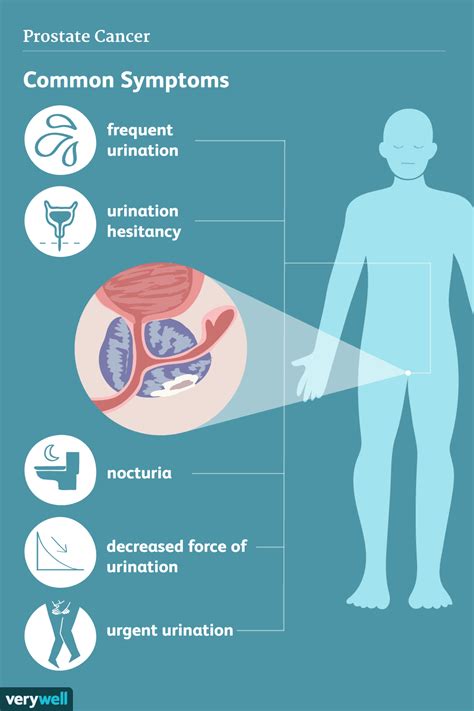 Prostate Cancer: Signs, Symptoms, and Complications