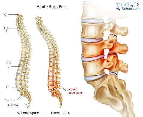 Low Back Pain Diagram