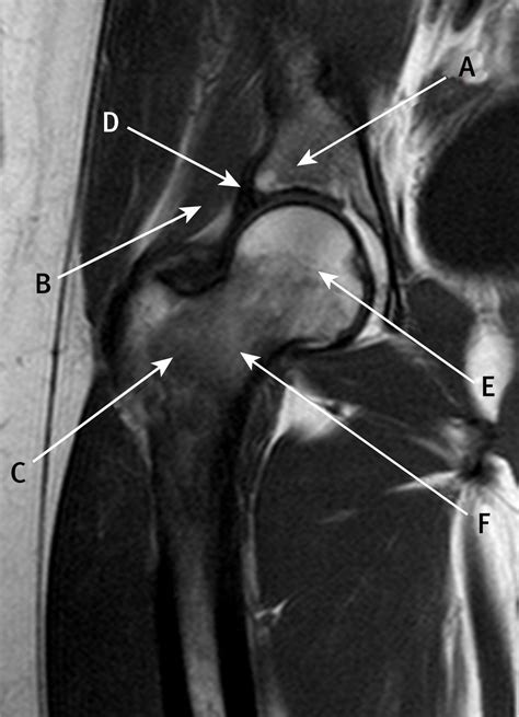 Coronal T2 weighted magnetic resonance imaging of the hip | The BMJ