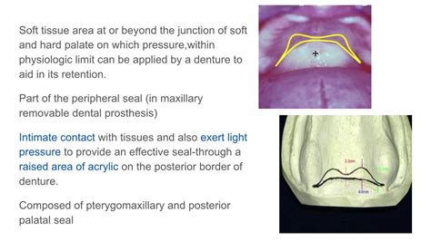 Posterior Palatal Seal(1/2) - YouTube