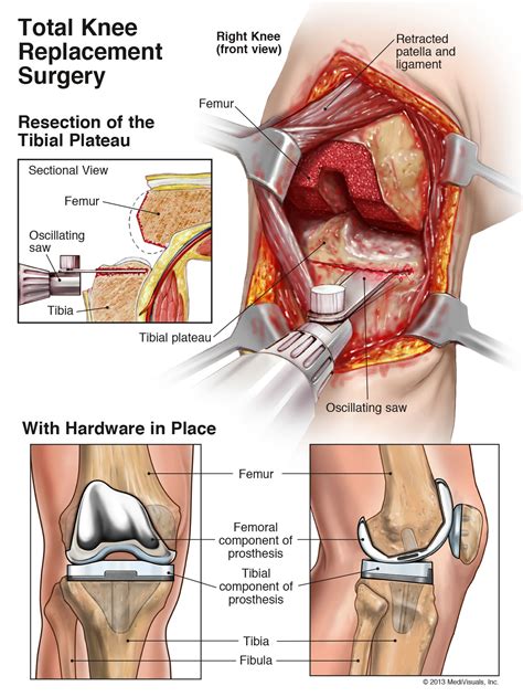 What Is Total Knee Replacement Surgery - Infoupdate.org