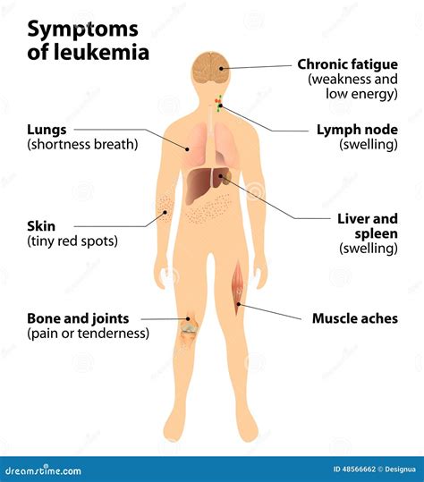 Symptoms Of Leukemia. Blood Cancer Stock Vector - Illustration: 48566662